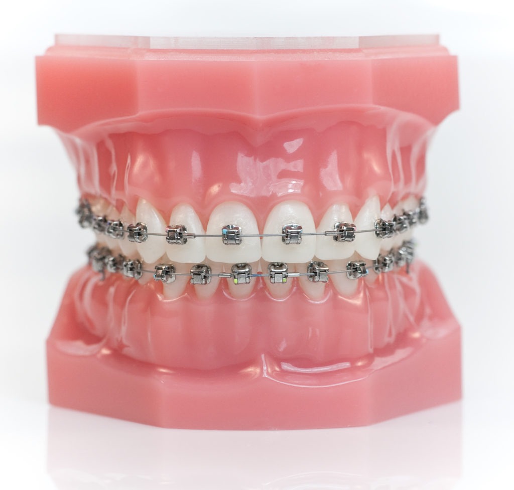 Braces Olathe